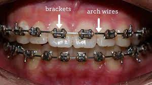 Braces that blend in with your teeth are inconspicuous and hard to spot. 4 Proven Ways To Straighten Crooked Or Misaligned Teeth