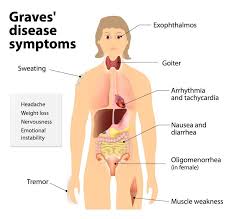 Faq Autoimmune Diseases Thyroid Dysfunction Hyperthyroidism Grave S Disease Hypothyroidism Hashimoto S Th Graves Disease Symptoms Graves Disease Thyroid Storm