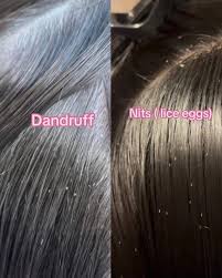 Image result for lice vs dandruff
