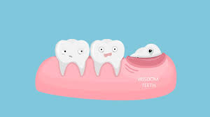 Ask your surgeon about any concerns you. 5 Things You Will Want To Know Before Getting Your Wisdom Teeth Pulled