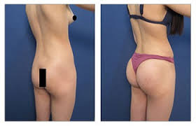 It can also take up to 6 months to see full results from the initial procedure. Safe Bbl Dr Mowlavi Answers The Important Question Is Bbl Safe