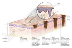 Surgical treatment for stage iii melanoma … The Cancer That Rises With The Sun Nature