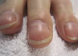 finger clubbing ile ilgili görsel sonucu