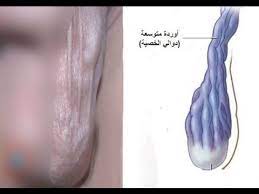 علاج الدوالي الخصية بالاعشاب سحر الاعشاب في علاج دوالي الخصية مشاعر اشتياق