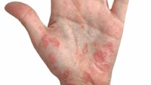 Image result for Hand Dermatitis