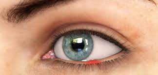 Gerstenkorn Oder Hagelkorn Im Auge