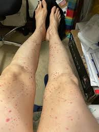 Image result for Vasculitis