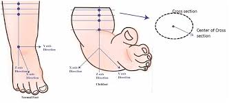 However, club foot is not a serious disorder and can be treated easily. Frontiers Developing A Three Dimensional 3d Assessment Method For Clubfoot A Study Protocol Physiology
