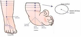 We did not find results for: Frontiers Developing A Three Dimensional 3d Assessment Method For Clubfoot A Study Protocol Physiology