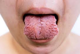 Slideshow What Your Tongue Says About Your Health Yeast Infection Treatment Candida Infection Candida Treatment