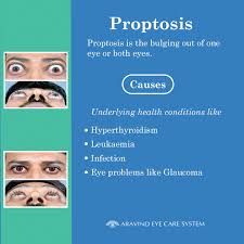 Image result for Proptosis