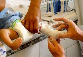 It won't go away on its own, but with early treatment, children experience good results. Non Surgical Treatment For Clubfoot Helps Those Who Can T Afford It Pbs Newshour