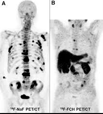 Immunohistochemical results show tumor cells stain: Evaluation Of Prostate Cancer Bone Metastases With 18f Naf And 18f Fluorocholine Pet Ct Journal Of Nuclear Medicine