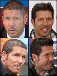 Últimas noticias, fotos, y videos de cholo simeone las encuentras en trome.pe. Implante Pelo Cholo Simeone Foro Coches