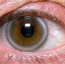 Липоидная дуга роговицы