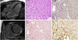 Congo red staining is usually used in diagnosing amyloidosis, a pathology characterized by the storage of in our work, studying a sudden death caused by cardiac amyloidosis and diagnosed only with postmortem exams, we present a modified congo red staining used with the purpose to. Cardiac Amyloidosis The Importance Of Surveillance In A Patient With An Initial Negative Cardiac Biopsy Sciencedirect