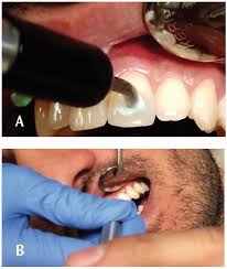 Palpatory percussion a combination of palpation and percussion, affording tactile rather than auditory impressions. Endodontic Diagnosis For The Dental Hygienist