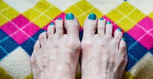 Image result for Clubbing nails feet