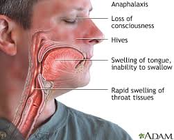 Image result for Anaphylaxis