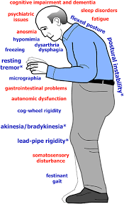 Parkinson S Disease Book Chapter Iopscience Physical examination revealed cogwheel rigidity in the upper limbs and impaired vibration sense which was absent in the lower limbs, reduced. parkinson s disease book chapter