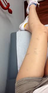 This Is What Kidney Failure Does To Your Body Como Tomarse Fotos Tumblr Tomar Fotos Tumblr Fotos Tumblr