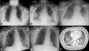 Performance of radiologists in differentiating covid 19 from viral pneumonia on chest ct A Recovered Case Of Covid 19 Myocarditis And Ards Treated With Corticosteroids Tocilizumab And Experimental At 001 Sciencedirect