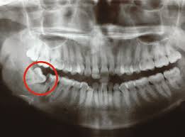 If you are experiencing infections of the soft tissue behind your last tooth or gum disease around the area in your mouth where the wisdom teeth are located, you may have a serious issue with your wisdom teeth. Problems With Erupting Wisdom Teeth Signs Symptoms And Management British Journal Of General Practice
