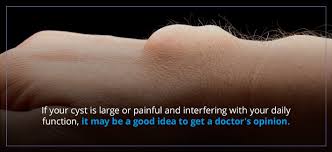 The treatment of cyst depends on the type of cyst, the location of the cyst in the body, causes of the cyst etc. What To Do When A Ganglion Cyst Ruptures Orthobethesda