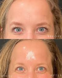 Laura Cady BSN, RN, CANS