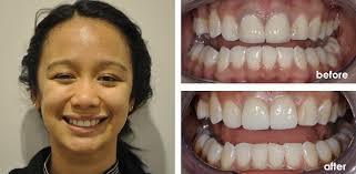 Because of its location front and center in the mouth, the dentist will usually recommend porcelain or composite resin as the filling material. Before And After Full Mouth Dental Implants The Point Dental