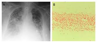 Planticola is quite similar in appearance to klebsiella pneumoniae and must be identified based on growth habits or dna analysis. Diseases Free Full Text Carbapenemase Producing Raoultella Planticola A Rare Cause Of Pneumonia And Bacteremia Html