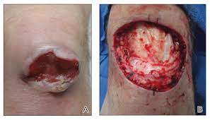 If a spot on your skin looks suspicious to you, there's one cardinal rule: Basal Cell Carcinoma Masquerading As A Dermoid Cyst And Bursitis Of The Knee Mdedge Dermatology