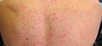 Maybe you would like to learn more about one of these? Manchas Rojas En La Piel Petequias Causas Y Tratamiento La Guia De Las Vitaminas