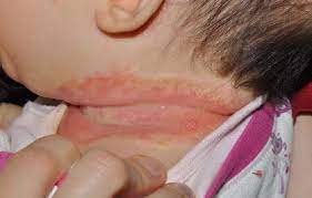 Lactacyd baby sabun untuk kulit sensitif bayi/ anak. Tip Sembuhkan Ruam Dan Luka Di Pelipat Kulit Bayi May 2021 Kelabmama Malaysia