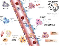 When breast cancer spreads to the brain it is considered stage 4 or metastatic breast cancer. Tumor Microenvironment Differences Between Primary Tumor And Brain Metastases Springerlink