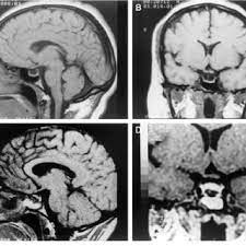 Clinical Features In 20 Patients With Empty Sella Syndrome Download Table