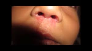 As this is a bacterial infection, treatment is done using antibiotics, such as dicloxacillin. Treating Nasal Vestibulitis