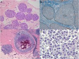 There is no cure, but new treatments may slow the progression and there are ways to relieve the symptoms. Lesiones Histologicas De Riesgo De Carcinoma De Mama Guia De Supervivencia Para El Patologo General Sciencedirect