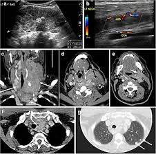 It can further evaluate the results of your mammogram for cancerous changes. Computed Tomography Of The Thyroid Wikipedia