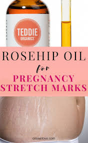 Bio Oil White Stretch Marks Before And After Pin On Stretch Mark Removal