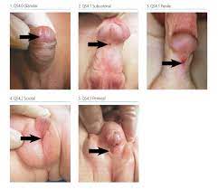4 8 Congenital Malformations Of Genital Organs Hypospadias Q54 0 Q54 9 Ncbddd Cdc
