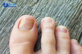 Loạn dưỡng móng: Nguyên nhân, triệu chứng, chẩn đoán, điều trị