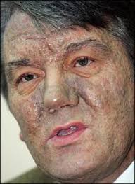 Serum dioxin, chloracne, and acne in veterans of operation ranch hand arch environ health , 53 ( 3 ) ( 1998 ) , pp. Dermatology Flashcards Quizlet