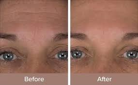 Microdermmd Home Microdermabrasion Skin Therapy Skin