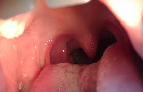 Continuum Nina Con Fiebre Y Amigdalitis Exudativa De Repeticion Sin Respuesta A Antibioticos