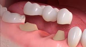 Pros & cons of valplast® flexible partials. Is The Price Of Flexible Dentures In The Philippines Worth It