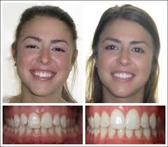 And they say that people may qualify for up to $3,000 in help from their insurance company. Lawrenceville Orthodontist Orthodontic Dentist In Lawrenceville New Jersey Roberts De Marsche Lawrenceville Orthodontist