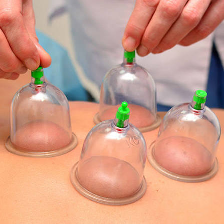 Cupping Therapy & Hijama in Dubai at Yuan Qi Acupuncture Center, Business Bay Dubai