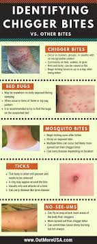 Identifying Chigger Bites Including Pictures Treatment And Remedy