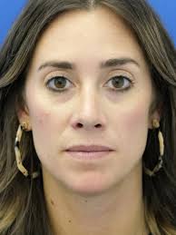 Cases in Rhinoplasty Preservation